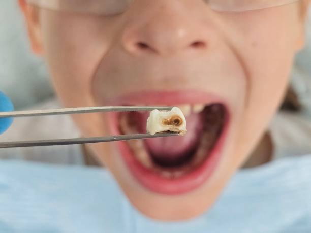 Best Emergency Dental Care for Abscessed Tooth in Woxall, PA